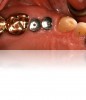 Figure 19. Close-up view of healing abutments in place for a patient who presented for implant restorations. Note this case was treated 4 years prior.