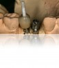 Figure 22. Petroleum jelly was placed onto the dowel, and the crown was loaded with cement, after which it was placed onto the abutment and fully seated. Given the depth of the patient’s sulcus, had the restoration been cemented intraorally, in all likelihood a tremendous amount of cement would have been retained in the peri-implant tissues, leading to peri-implant disease.