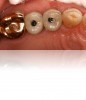 Figure 26. View of the “screwmentable” abutment/restorations in place in the mouth, prior to closing the access holes with composite.