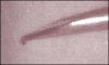 Fig 3. Enlarged view of the same syringe after an injection. Note the barb on the end resulting from bumping the bone and drawing back, which could traumatize the nerve and cause paresthesia.