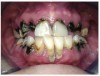 Fig 7 through Fig 9. This young patient’s only prosthetic option was extraction of all remaining teeth and subsequent placement of complete dentures.