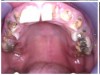 Fig 4 through Fig 6. Patient’s oral condition after 6 years of meth use.