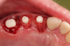 Fig 2. Extractions and immediate placement.