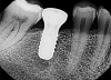 Fig 3. Non-restorable implant that would have benefited from collaboration earlier.