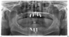 Fig 4. Unworkable result due to lack of teamwork between the surgeon and the restorative dentist.