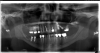 Fig 5. Placement at No. 14 and 15 sites was not optimal for implant restorations.