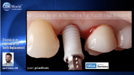 Zirconia as an Alternative for Tooth Replacement Webinar Thumbnail
