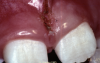 Fig 4 through Fig 6. Maxillary labial frenectomy for a 7-year-old female patient, immediately postoperative (Fig 4), after 1 week (Fig 5), and after 5 years (Fig 6).