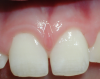 Fig 4 through Fig 6. Maxillary labial frenectomy for a 7-year-old female patient, immediately postoperative (Fig 4), after 1 week (Fig 5), and after 5 years (Fig 6).