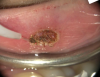 Fig 7 through Fig 9. Fibroma removal, preoperative intraoral (Fig 7) through postoperative (Fig 9) photographs.