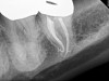 Fig 7. Cases treated by the continuous wave of condensation technique using gutta percha and epoxy resin sealer.