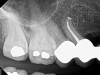 Fig 8. Cases treated by the continuous wave of condensation technique using gutta percha and epoxy resin sealer.