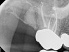 Fig 9. It is clinically acceptable to have results with the sealer puff (Figure 9) and without (Figure 10).