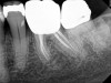 Fig 10. It is clinically acceptable to have results with the sealer puff (Figure 9) and without (Figure 10).