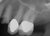 Fig 8. Preoperative periapical radiograph.