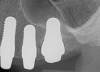 Fig 9. 12-week postoperative periapical radiograph.