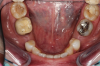 Fig 11. Preoperative healed sites.