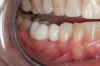 Fig 15. Provisionals 12 weeks postoperatively.