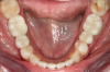 Fig 16. Final restorations (15 weeks postoperatively).