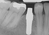 Fig 17. 12-week postoperative radiograph.