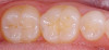 Figure 1  Susceptible pit and fissures on occlusal surface of molar.