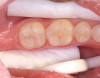 Figure 4  Etched occlusal surface.
