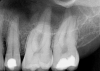 Fig 3. Preoperative maxillary left bicuspid.