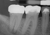 Fig 7. Primary endodontic and secondary periodontal lesion, mandibular second molar.