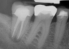 Fig 9. 33 days postoperative fiber-post placement and CAD crown.