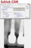 Figure 2 If the Schick CDR sensor is compared to the most recent Schick 33 sensor, dramatic differences can be seen in resolution and image file size. Both images were taken at the default settings and were not manipulated. The actual size of the images was taken from the image descriptions in the software; the Schick CDR sensor image is under 400 kilobytes, whereas the newer Schick 33 sensor image is over 4 megabytes, which is more than 10 times larger.