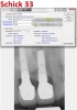 Figure 3. If the Schick CDR sensor is compared to the most recent Schick 33 sensor, dramatic differences can be seen in resolution and image file size. Both images were taken at the default settings and were not manipulated. The actual size of the images was taken from the image descriptions in the software; the Schick CDR sensor image is under 400 kilobytes, whereas the newer Schick 33 sensor image is over 4 megabytes, which is more than 10 times larger.