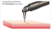 Figure 2 Incision/excision/ablation with a focused laser.