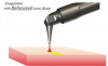 Figure 3 Coagulation with a defocused laser beam.