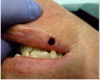 Figure 14 The immediate postoperative view. A thin layer of char was created as a precautionary measure to protect the surgical site. No sutures were placed and the surgical wound was left to heal by secondary intention.