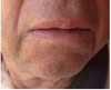 Figure 15 The 1-month postoperative view. Note the complete healing with no scarring.