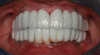 Full-arch prosthesis showing minimal-to-no plaque around both the top and bottom peri-implant tissues after oral irrigator use.